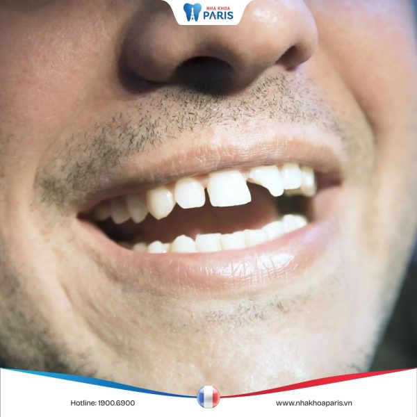 Răng sứt mẻ là gì? Cách khắc phục hiệu quả, Bác sĩ nha khoa giải đáp