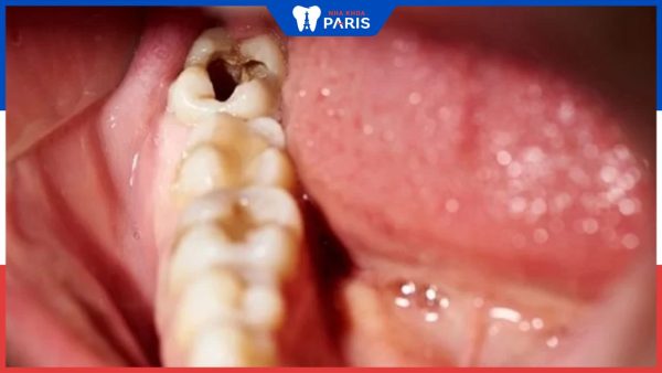 Răng trong cùng bị hôi: Nguyên nhân và biện pháp điều trị