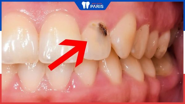 Sâu chân răng: Nguyên nhân và phương pháp điều trị dứt điểm