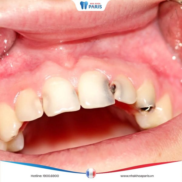 Sâu kẽ răng: Điều trị hiệu quả, ngăn ngừa tái phát