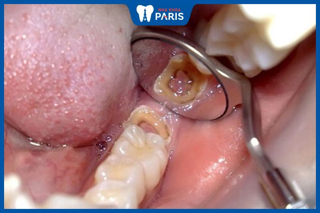 Sâu ở răng trong cùng ảnh hưởng tới sức khỏe và cuộc sống