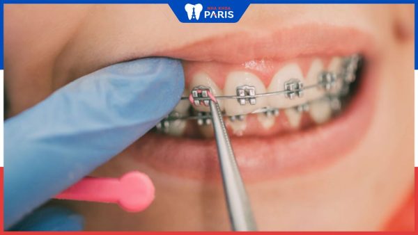 Siết răng khi niềng là gì? Lợi ích và quy trình của siết răng