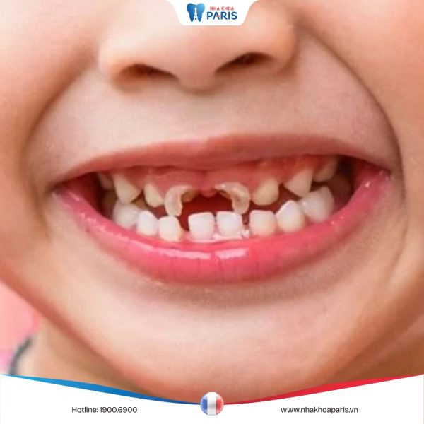 Sún răng là gì? Tác hại khi trẻ bị sún răng? Bác sĩ giải đáp