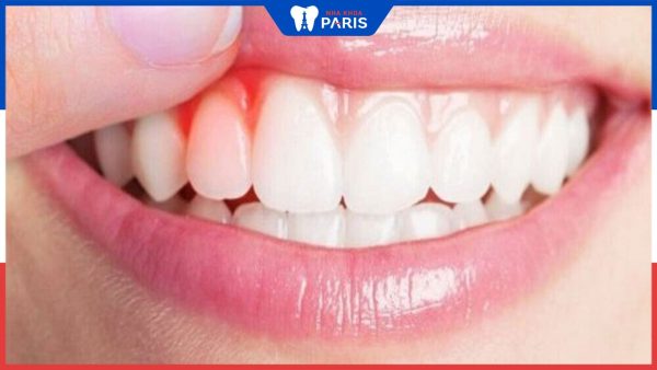 Sưng lợi răng cửa: Dấu hiệu, nguyên nhân và biện pháp điều trị