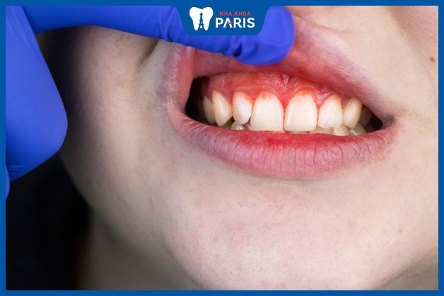 Sưng lợi ở răng cửa gây ra nhiều hậu quả nghiêm trọng