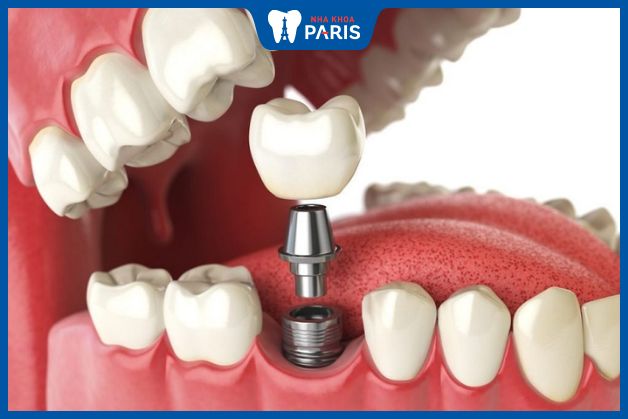 Trồng răng Implant không ảnh hưởng đến răng khác