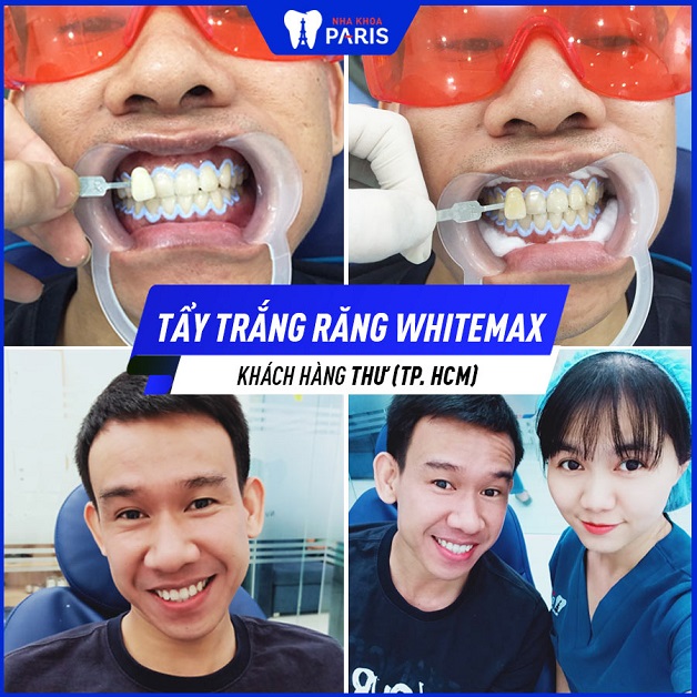Khách hàng Thư (TPHCM) sở hữu hàm răng trắng bật tông sau khi sử dụng công nghệ WhiteMax