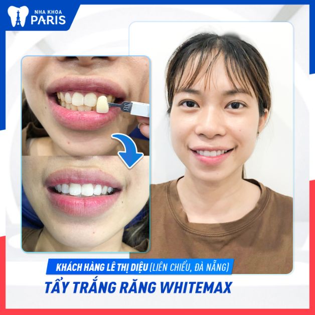 Kết quả thẩm mỹ sau khi tẩy trắng răng WhiteMax duy trì từ 3 - 5 năm