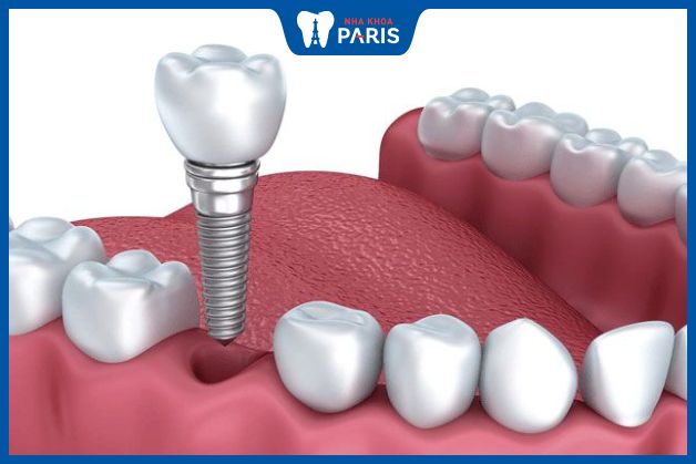Thời gian hoàn tất quá trình trồng răng Implant là bao lâu