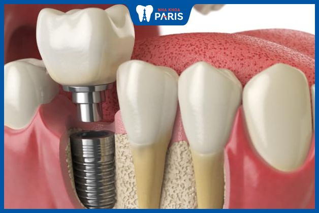 Thời gian tích hợp xương của răng hàm lâu hơn răng cửa