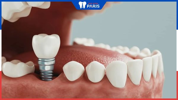 Thời gian trồng răng Implant là bao lâu, Các yếu tố tác động tới quá trình trồng răng
