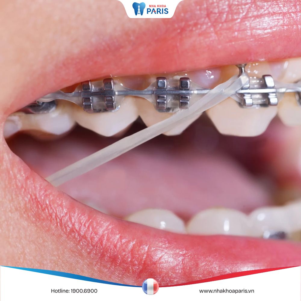 Thun liên hàm: Giải pháp cho tình trạng khớp hàm bị lệch