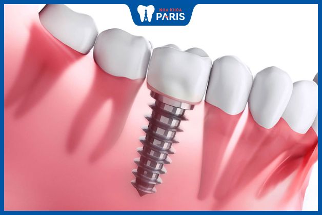 Trồng răng Implant giúp ngăn chặn tiêu xương
