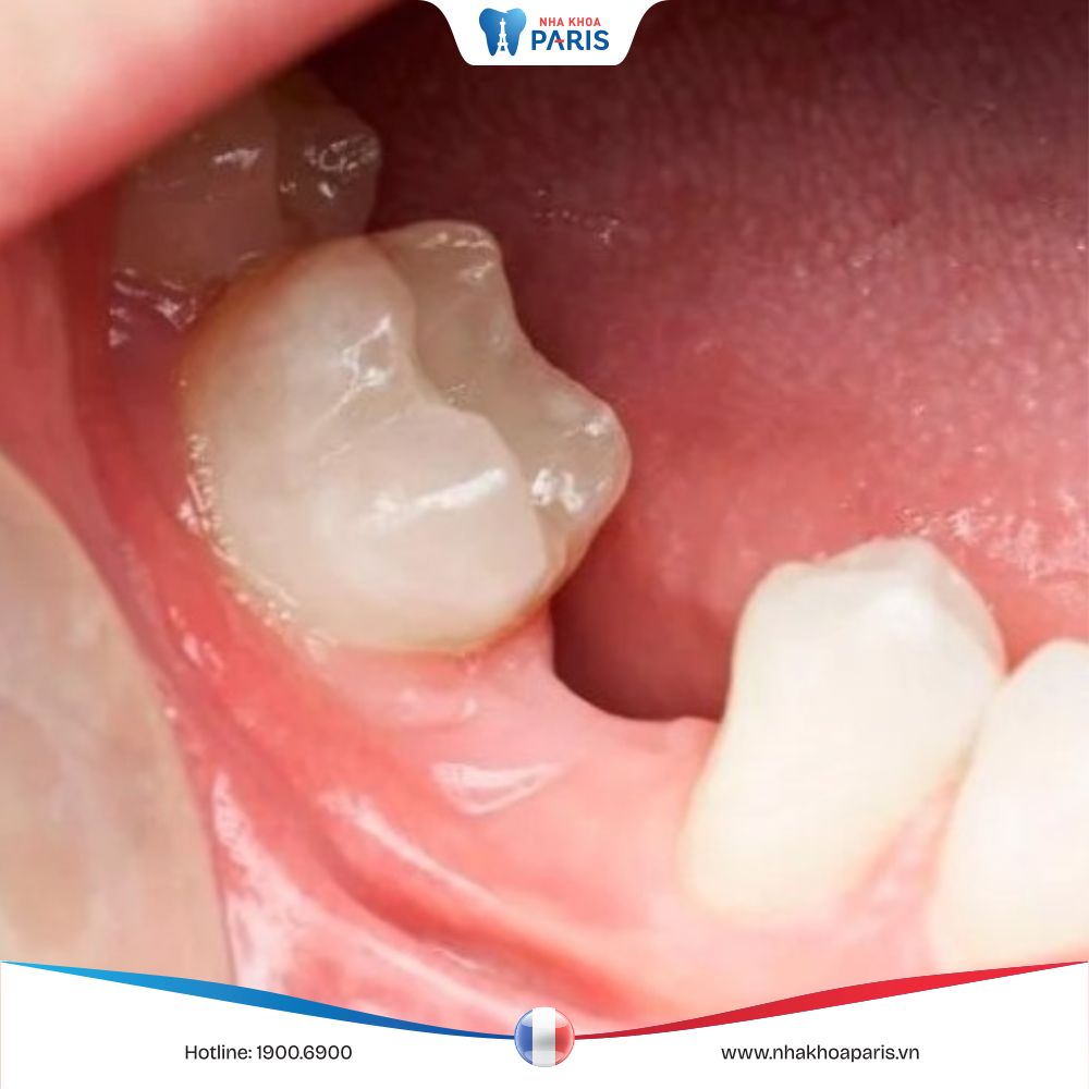 Tình trạng tiêu xương ổ răng và 7 hệ lụy vô cùng nghiêm trọng