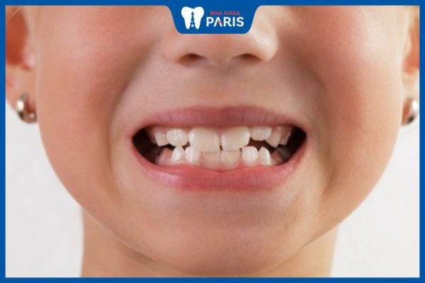 Nguyên nhân gây nghiến răng ở trẻ nhỏ