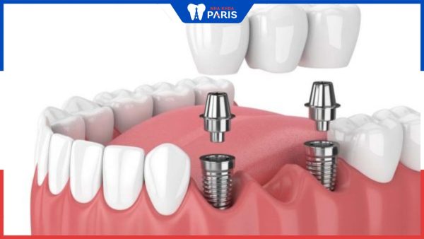Các phương pháp trồng 3 răng liên tiếp hiệu quả nhất hiện nay