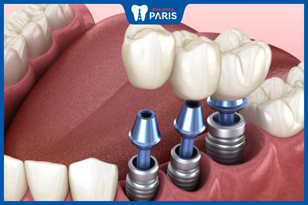 Trồng răng Implant 3 răng liên tiếp