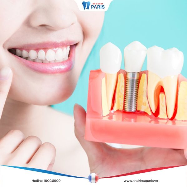 Trồng răng Implant bao lâu thì lành và cách chăm sóc