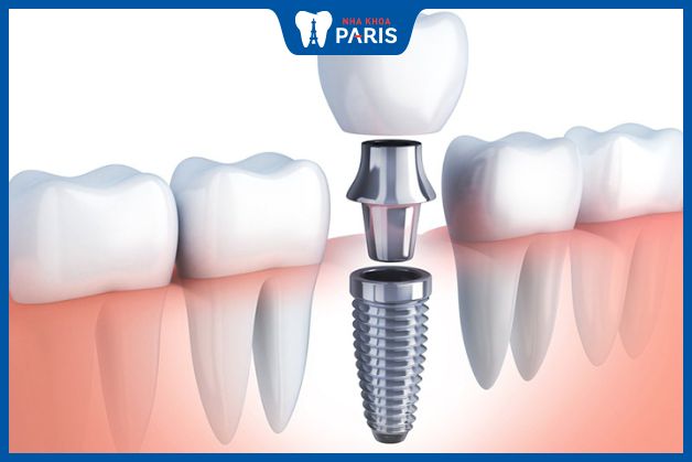 Trồng Implant răng cấm là phương pháp phục hình răng an toàn, hiệu quả