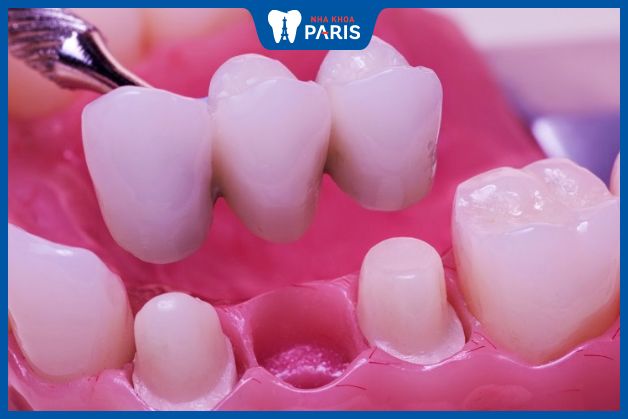 Cầu răng sứ được thiết kế để phục hình răng cấm đã mất nhờ hai răng trụ bên cạnh