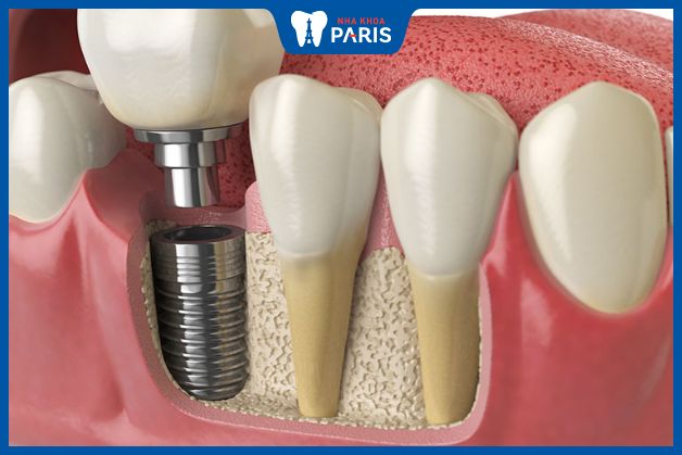 Trồng răng hàm không gây đau khi thực hiện