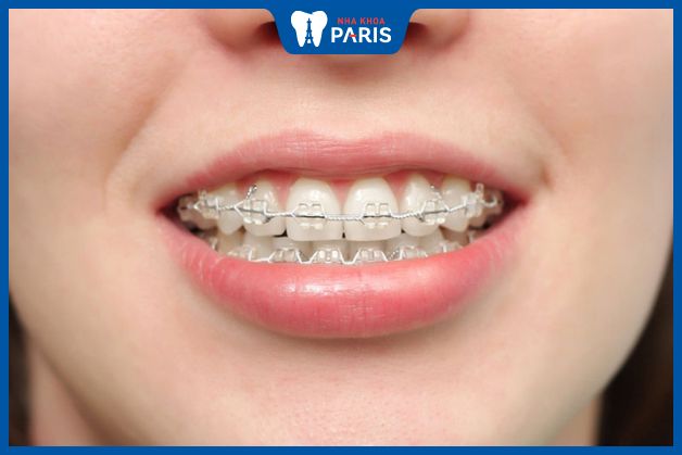Niềng răng có thể ảnh hưởng nghiêm trọng đến độ bền của răng giả 
