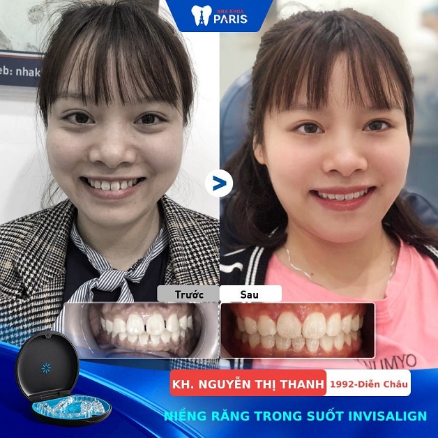 Khách hàng Nguyễn Thị Thanh sau khi niềng răng trong suốt Invisalign