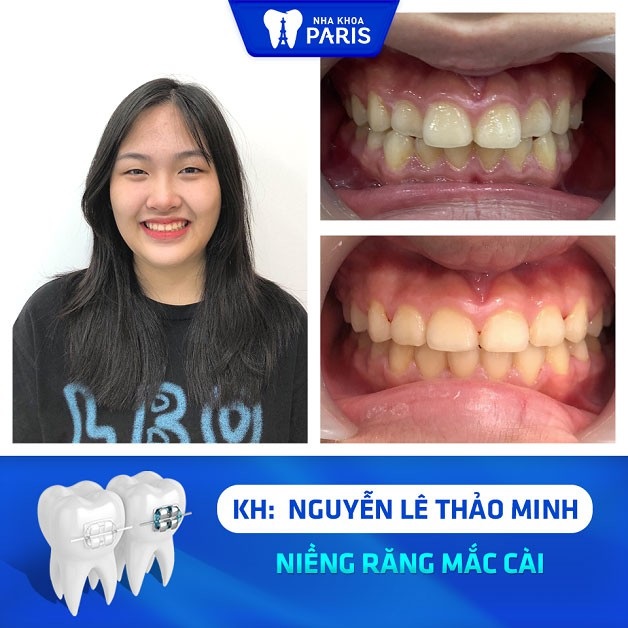 Khách hàng Nguyễn Lê Thảo Minh hài lòng với hàm răng của mình sau khi niềng