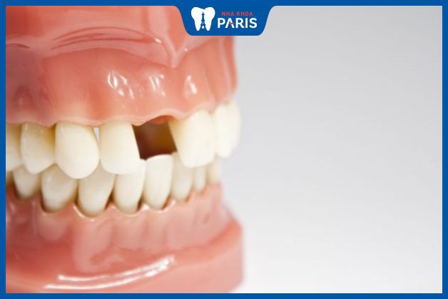Số lượng răng cần phục hình nhiều thì càng mất nhiều thời gian hơn