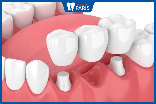 Phương pháp làm cầu răng sứ cũng được nhiều khách hàng lựa chọn bởi chi phí phải chăng