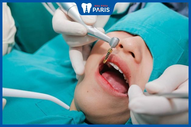 Tham khảo các bước phục hình răng hàm tại Nha Khoa Paris