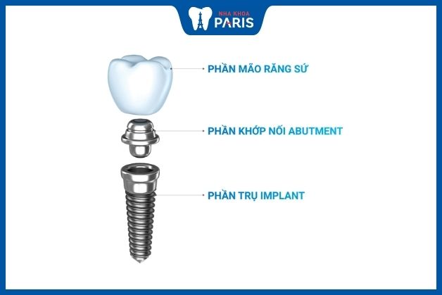 Răng sứ được gắn trên trụ Implant thông qua khớp nối Abutment