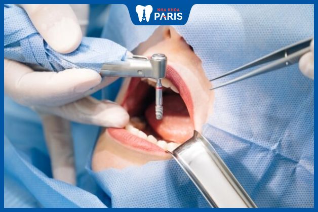 Trồng răng Implant ngăn ngừa tiêu xương hàm