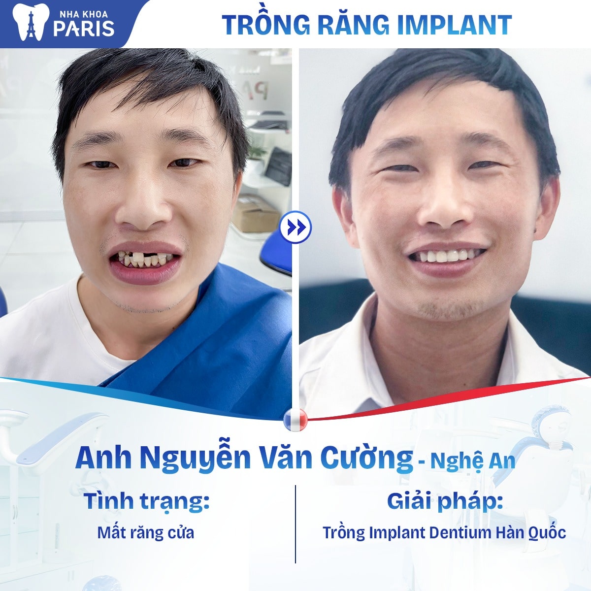 Anh Nguyễn Văn Cường sau khi thực hiện phương pháp trồng Implant Dentium Hàn Quốc
