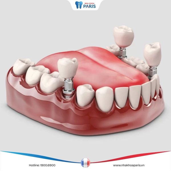 Trồng răng Implant: Ưu điểm và nhược điểm của trồng răng