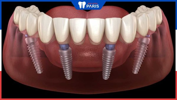 Trồng răng Implant All On 4: Giải pháp trồng răng toàn hàm