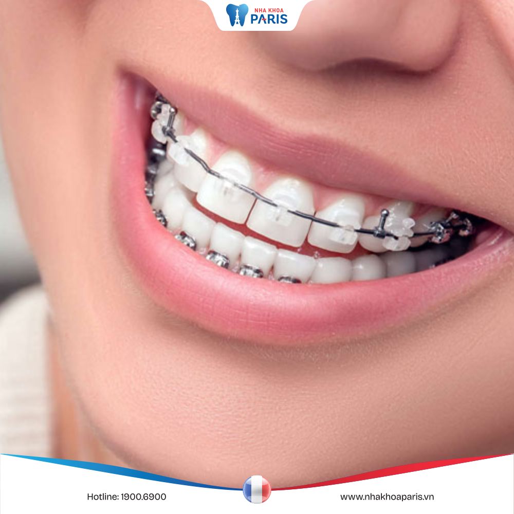 Giải đáp: Trồng răng Implant có niềng được không? Tại sao?