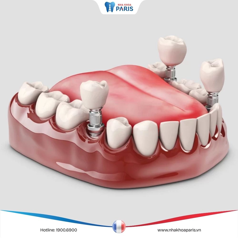 Trồng răng Implant: Ưu nhược điểm, ai nên thực hiện, chi phí