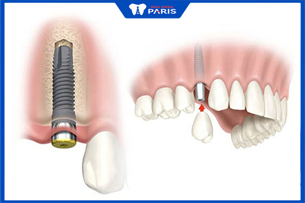 Cấy ghép Implant là giải pháp tạo hình răng khểnh đẹp, độ bền lâu dài