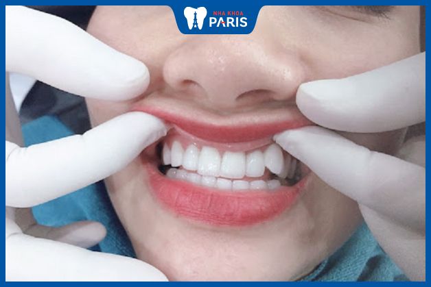 Chị Thu Hà sau khi hoàn thành tạo hình răng khểnh bằng phương pháp cắm trụ Implant