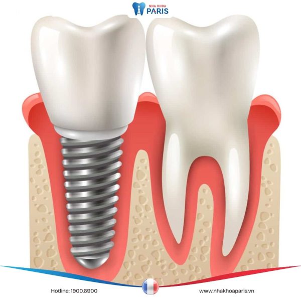 3 phương pháp trồng răng số 6 hiệu quả, phổ biến tại nha khoa