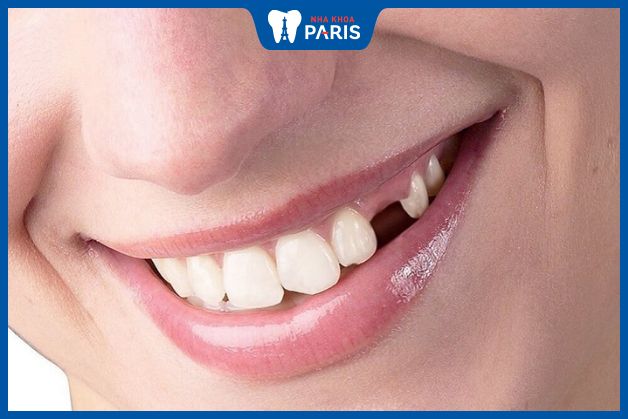 Trụ Biotem phù hợp với trường hợp mất 1 răng