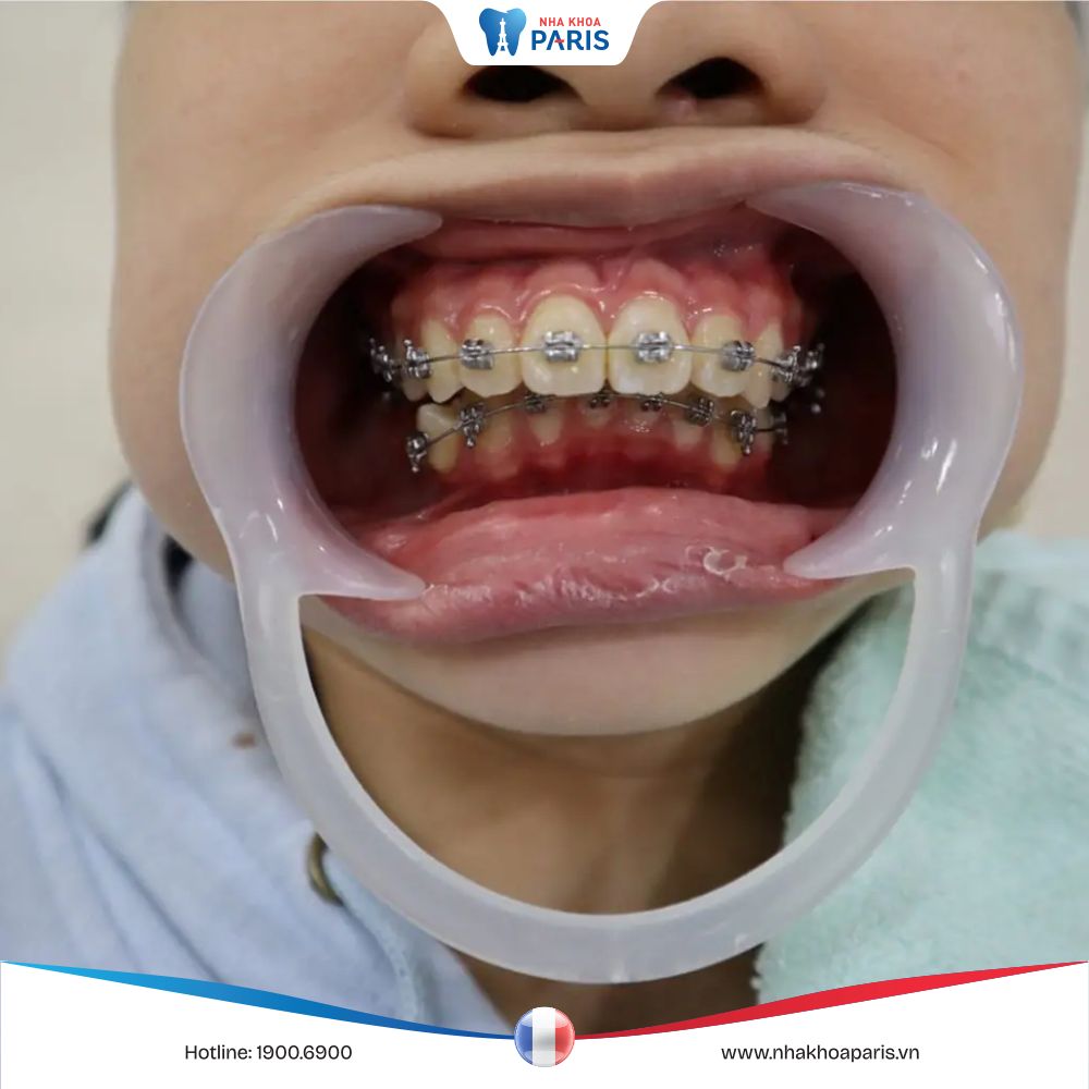 Cách khắc phục tụt lợi khi niềng răng đơn giản, hiệu quả
