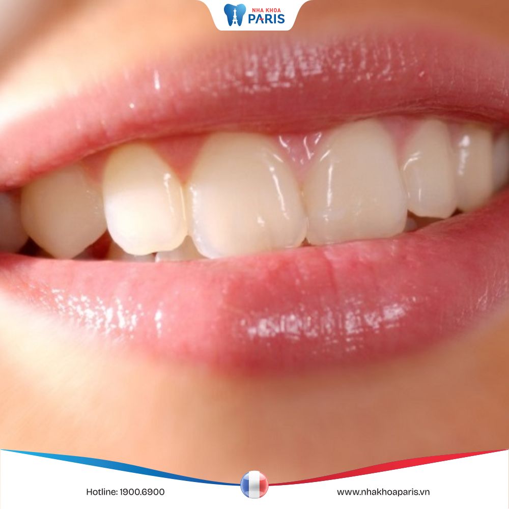 Mất răng cửa gây ra những tác hại gì? Lưu ý khi trồng răng cửa