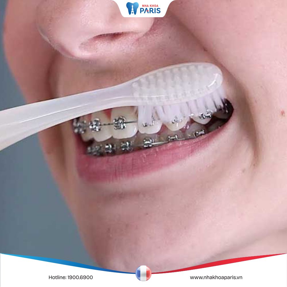 Cách chăm sóc răng miệng khi niềng răng để đạt hiệu quả tốt