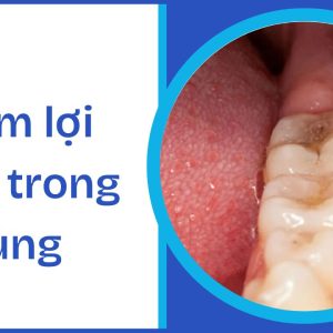 Viêm lợi răng trong cùng: Nguyên nhân, dấu hiệu và cách điều trị hiệu quả