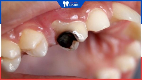 Viêm tủy răng có nguy hiểm không? Các giai đoạn viêm tủy răng
