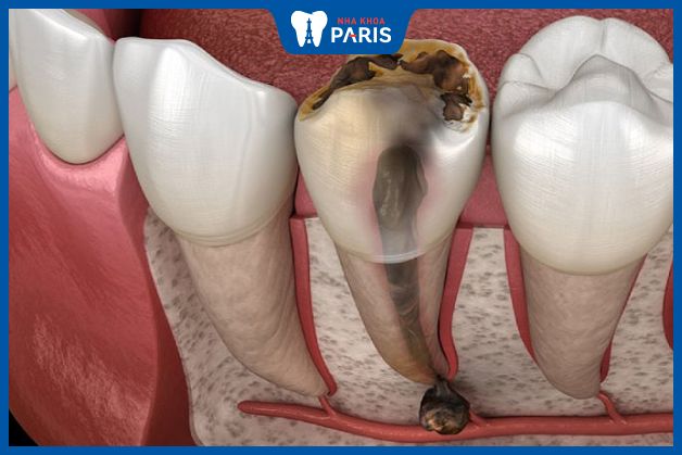 Chân răng yếu, bề mặt răng xuất hiện đốm đen là dấu hiệu viêm tủy răng nặng