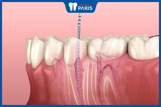 Viêm quanh cuống răng là một trong những biến chứng của viêm tuỷ răng