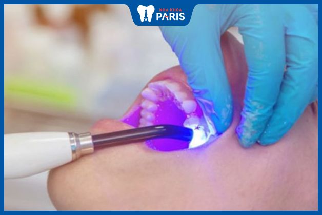 Laser Tech là phương pháp hàn trám răng hiện đại tại Nha Khoa Paris
